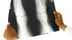 Καινοτόμα εμφυτεύματα χόνδρου για αποκατάσταση αρθρώσεων: Η επανάσταση στην αναγεννητική ιατρική