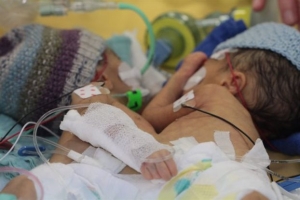 Σιαμαία κοριτσάκια διαχωρίστηκαν 8 ημέρες μετά τη γέννησή τους