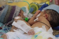 Σιαμαία κοριτσάκια διαχωρίστηκαν 8 ημέρες μετά τη γέννησή τους